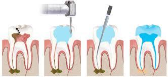 Root Canal